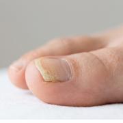 https://static-s1.sanego.de/Krankheit/180/nagelpilz-fuss.jpg