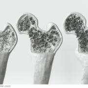 https://static-s1.sanego.de/Krankheit/180/osteoporose-3d-rendering_crevis.jpg