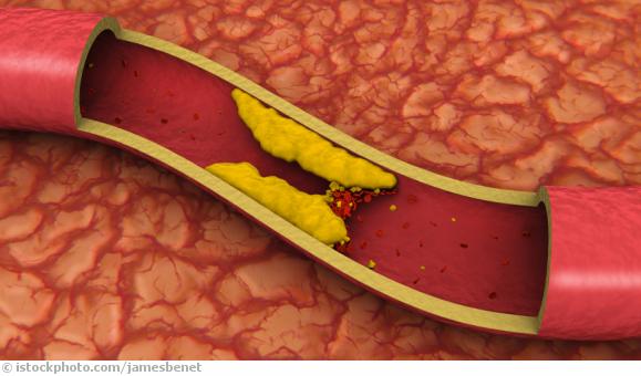 Angina pectoris Angina pectoris
