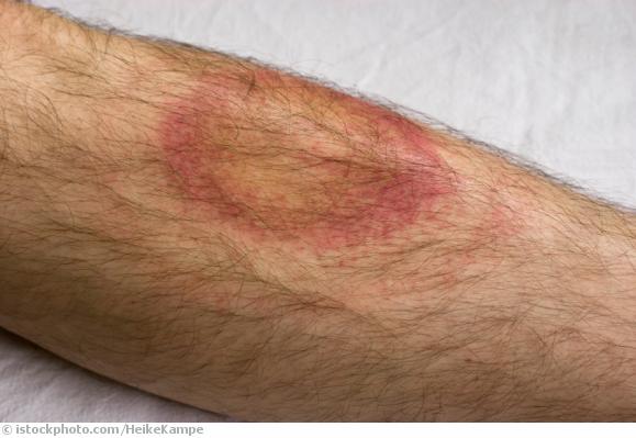 Borreliose Borreliose