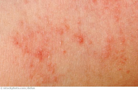 Dermatitis Dermatitis