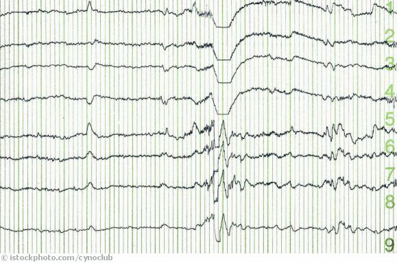 Epilepsie Epilepsie