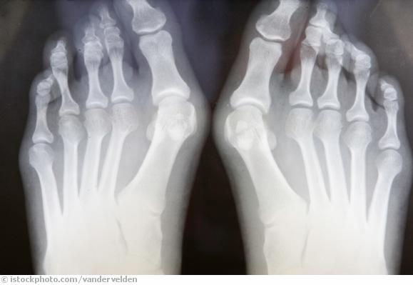 Hallux Hallux