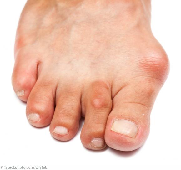 Hallux Hallux