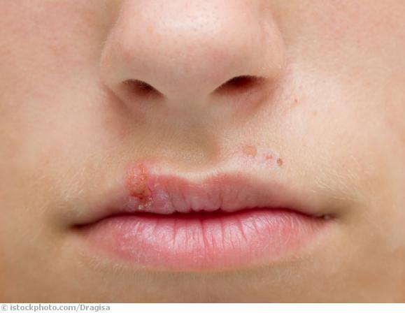 Lippenherpes Lippenherpes