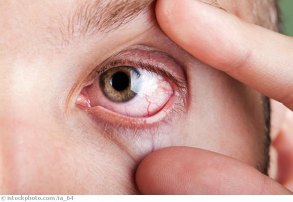 trockene Augen trockene Augen