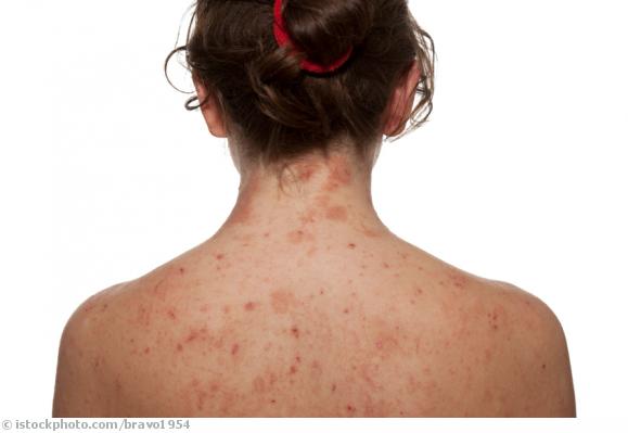 Dermatitis Dermatitis