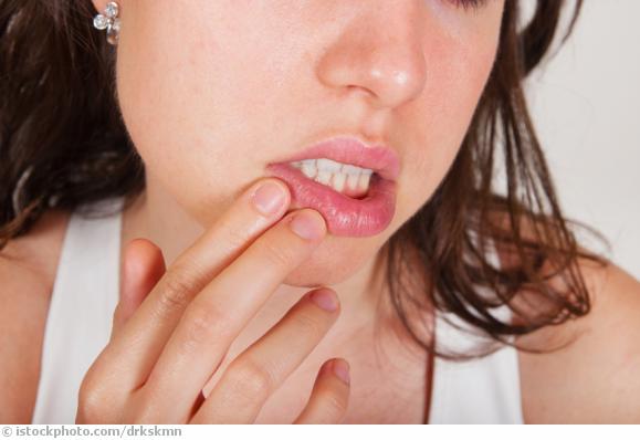 Lippenherpes Lippenherpes
