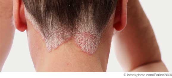 Krankheit: Hilfe bei Psoriasis - Medikamente und ...