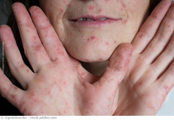 https://static-s1.sanego.de/Krankheit/hand-fuss-mund-erwachsen-copy_579x386.jpg