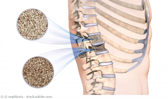 https://static-s1.sanego.de/Krankheit/osteoporose-im-rueckenwirbel_sagittaria.jpg